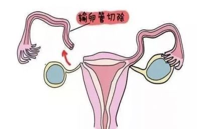 江苏慈铭博鳌国际医院三代试管婴儿，切除双侧输卵管还能做试管婴儿吗？