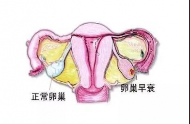 江苏备孕试管婴儿知识_为什么年轻女性也会卵巢早衰？如何防止早衰？